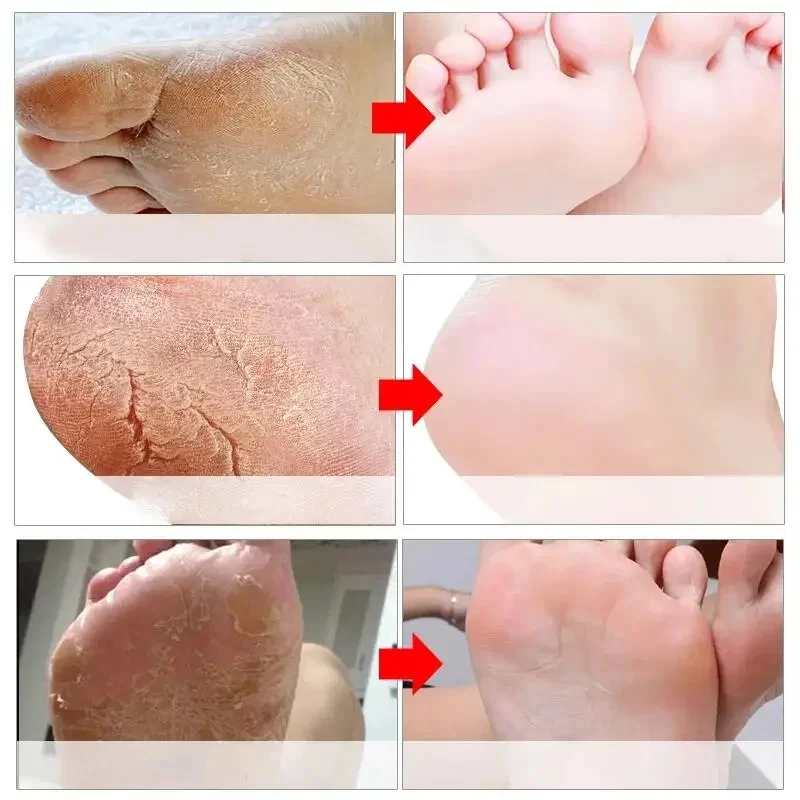 Crema antigrietas para manos y pies,reparación - Imagen 2